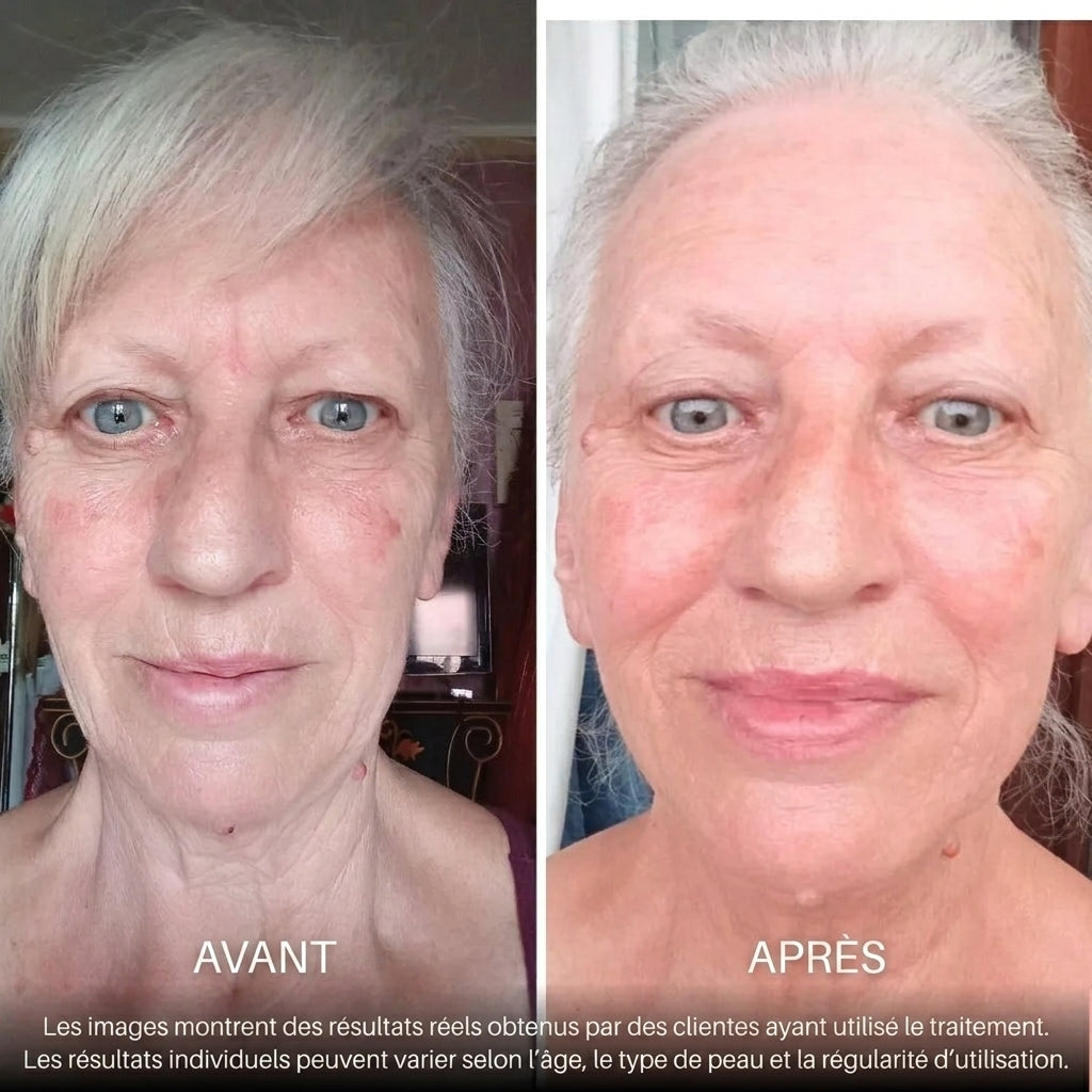 BioVolume+ | Microinfusion Lèvres
